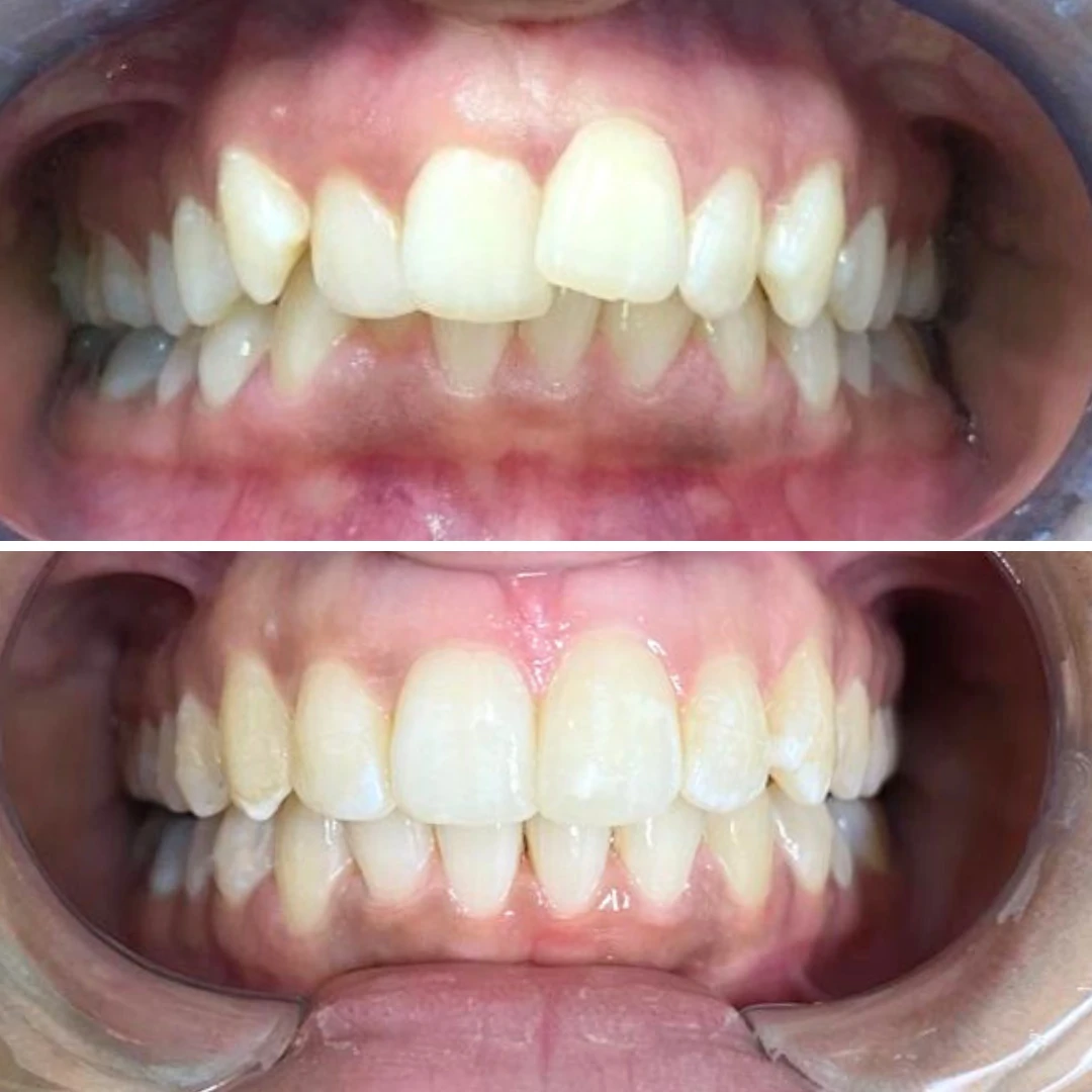 Orthodontic crowding and rotation correction before and after in Mississauga