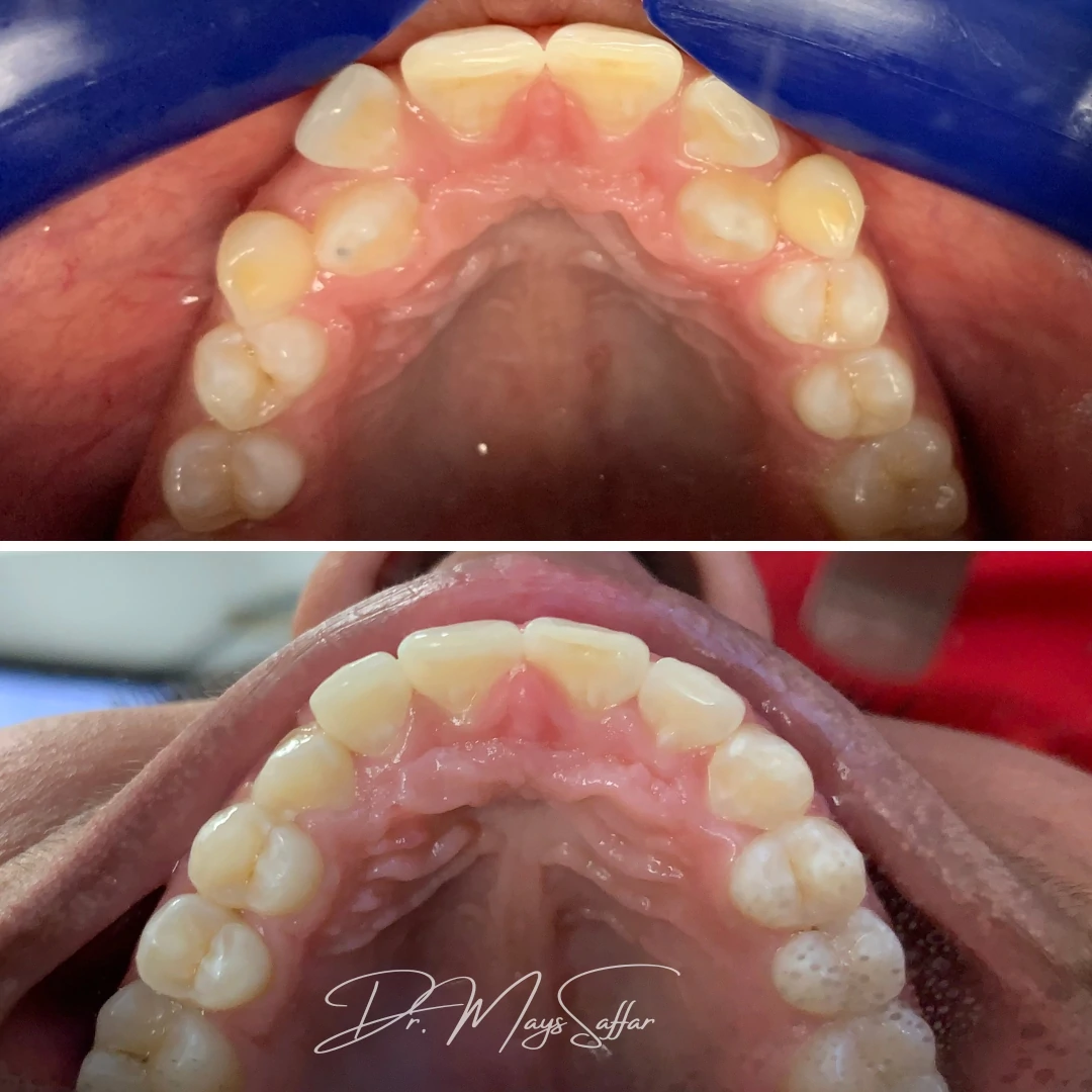 Orthodontic upper arch expansion before and after showing improved alignment at North Star Dentistry