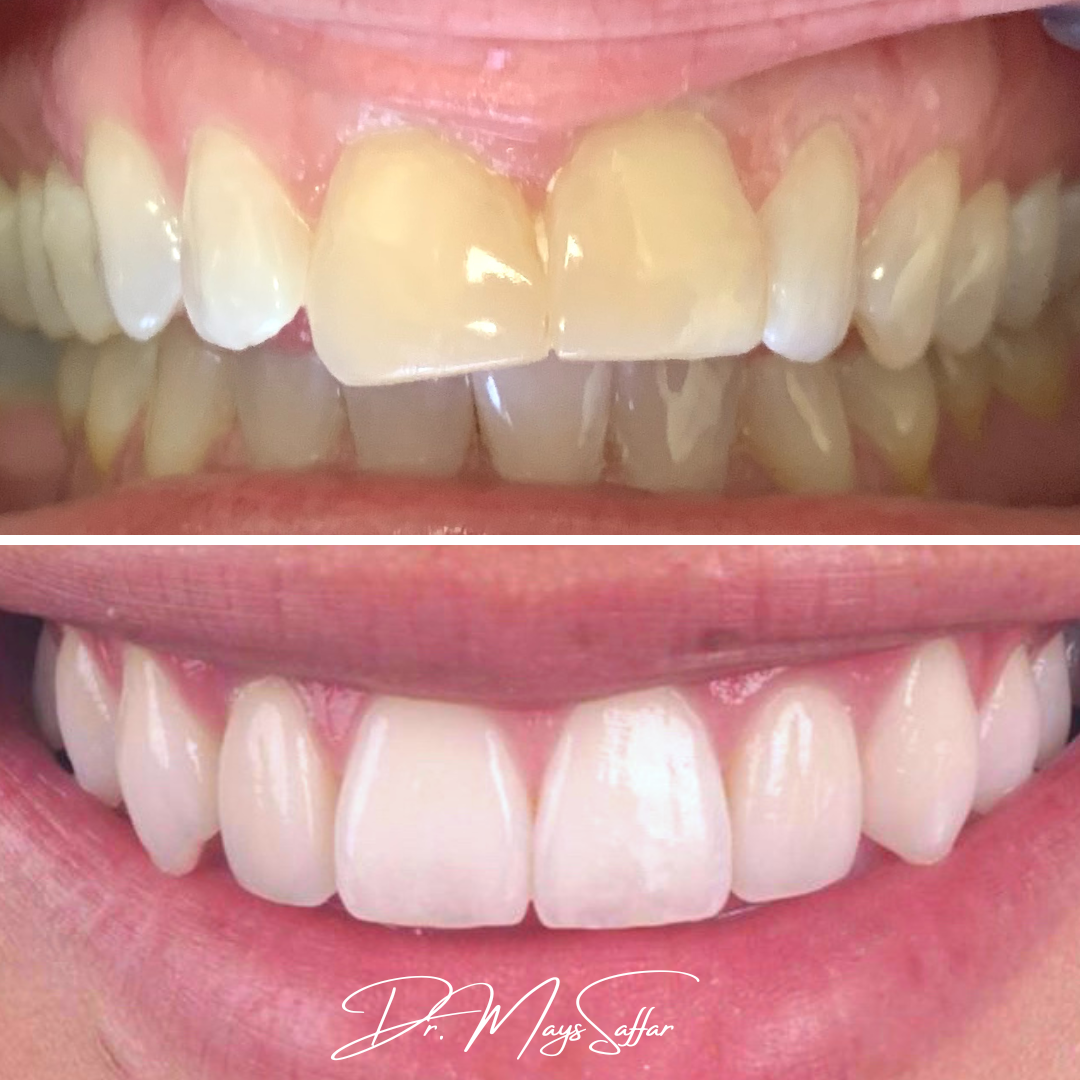 Porcelain veneers before and after creating a brighter, more uniform smile by Dr. Mays Saffar in Mississauga