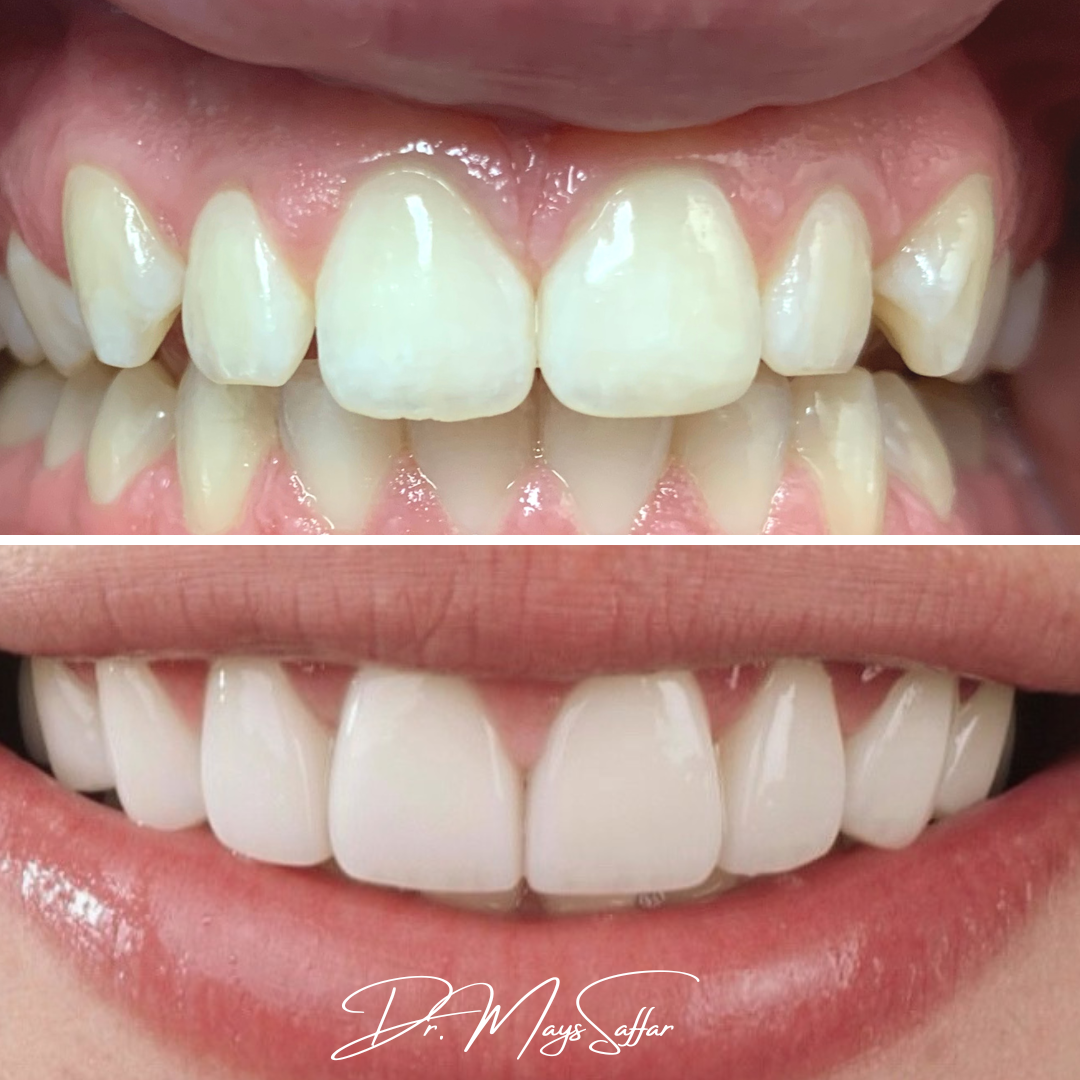 Porcelain veneers before and after correcting peg laterals and tooth shape at North Star Dentistry Mississauga