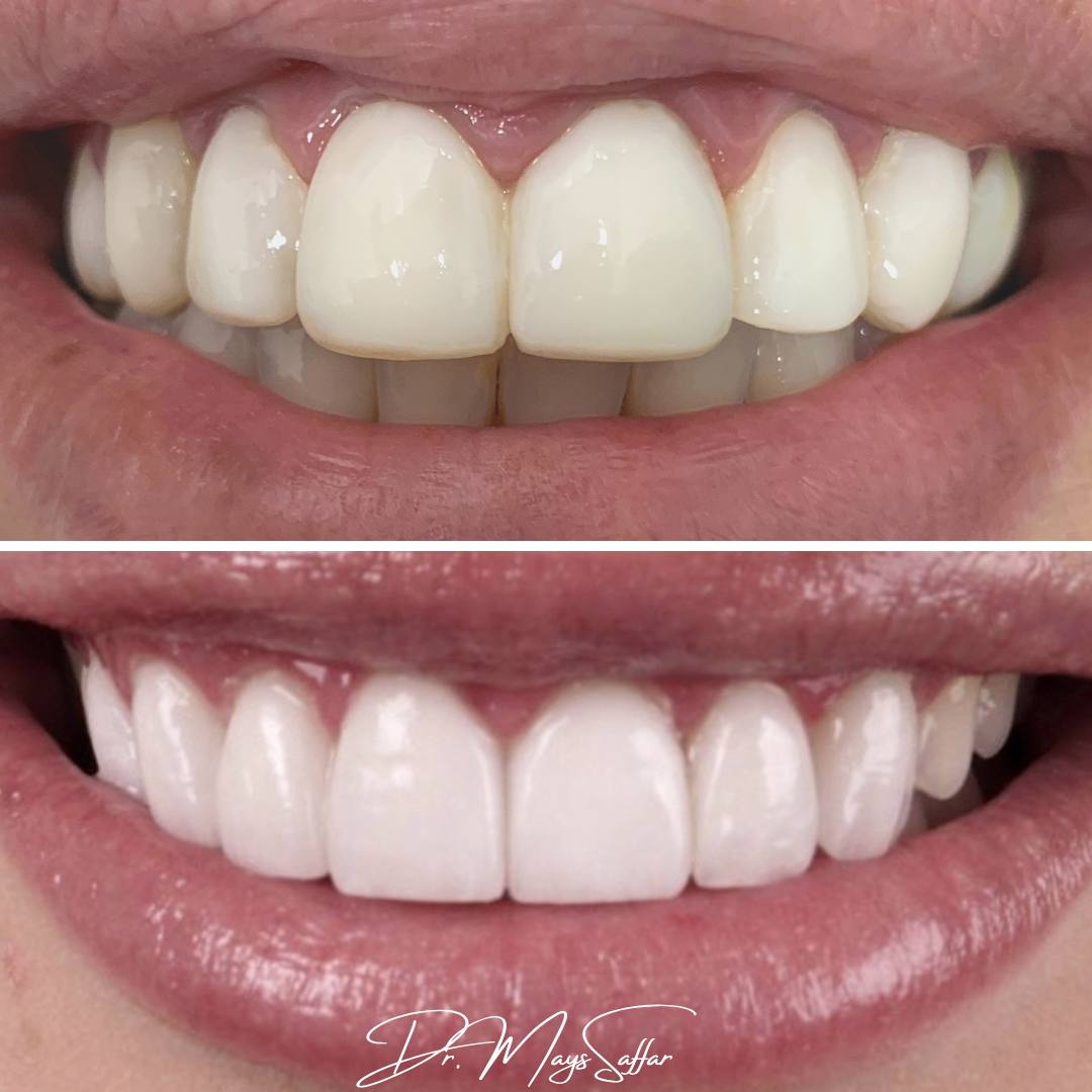 Porcelain veneers before and after smile makeover by Dr. Mays Saffar at North Star Dentistry Mississauga