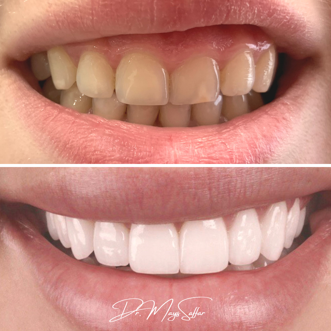 Porcelain veneers before and after full upper smile transformation by Dr. Mays Saffar in Mississauga