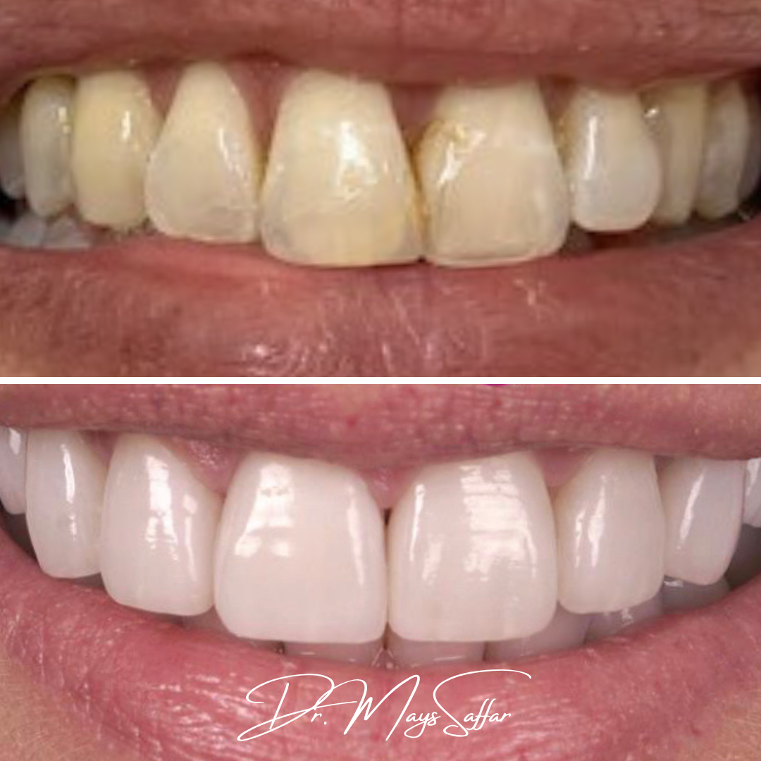Porcelain veneers before and after restoring worn and stained front teeth by Dr. Mays Saffar at North Star Dentistry Mississauga