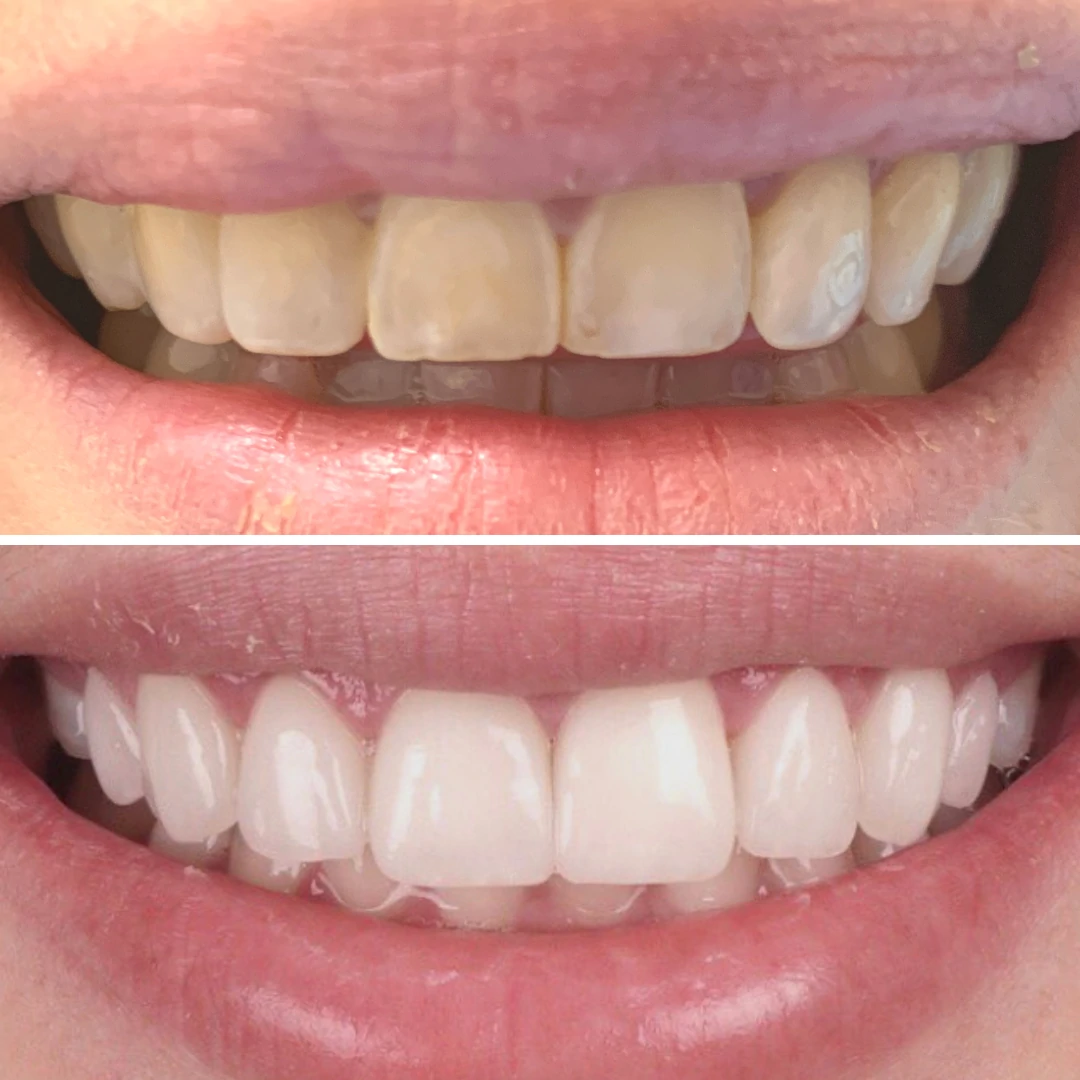 Porcelain veneers before and after smile transformation correcting yellow worn teeth at North Star Dentistry Mississauga