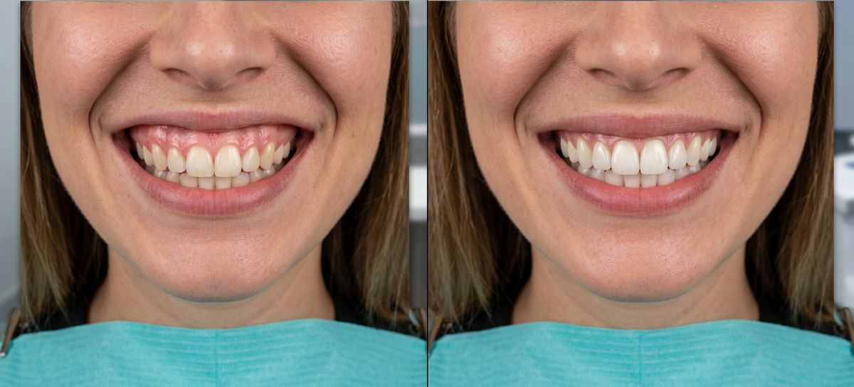 Gummy smile treatment Mississauga – before and after comparison showing reduced gum display following targeted correction at North Star Dentistry